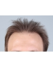 Before Hair Transplant &nbsp;2 Sessions (Areas)